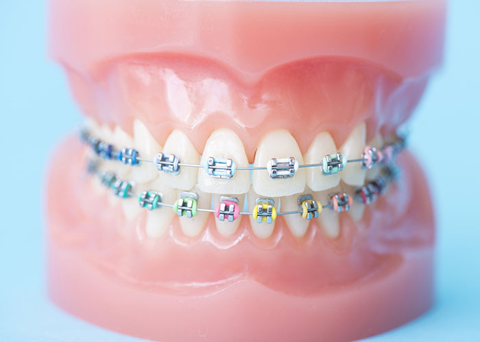 歯科矯正の模型
