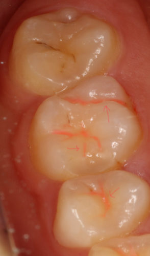 奥歯の初期虫歯を防ぐには シーラント 歯医者をお探しなら大森でインプラントに対応する 沢田通り歯科